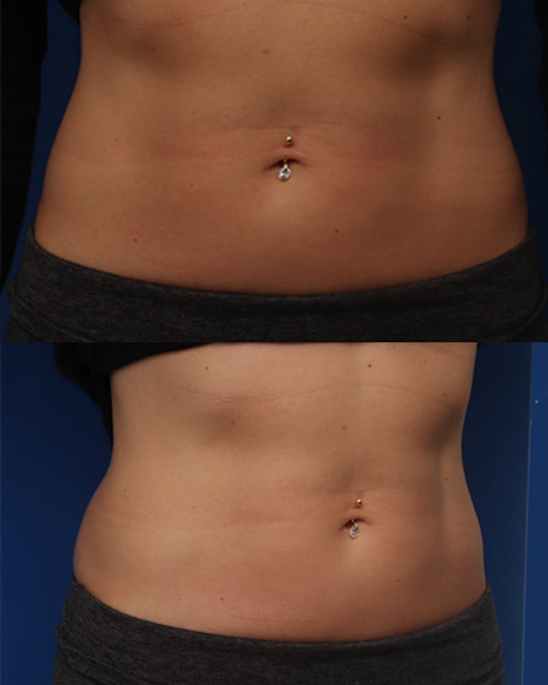Patient KGqdTI4BS2yeiFrE7fuEog - Evolve Before & After Photos
