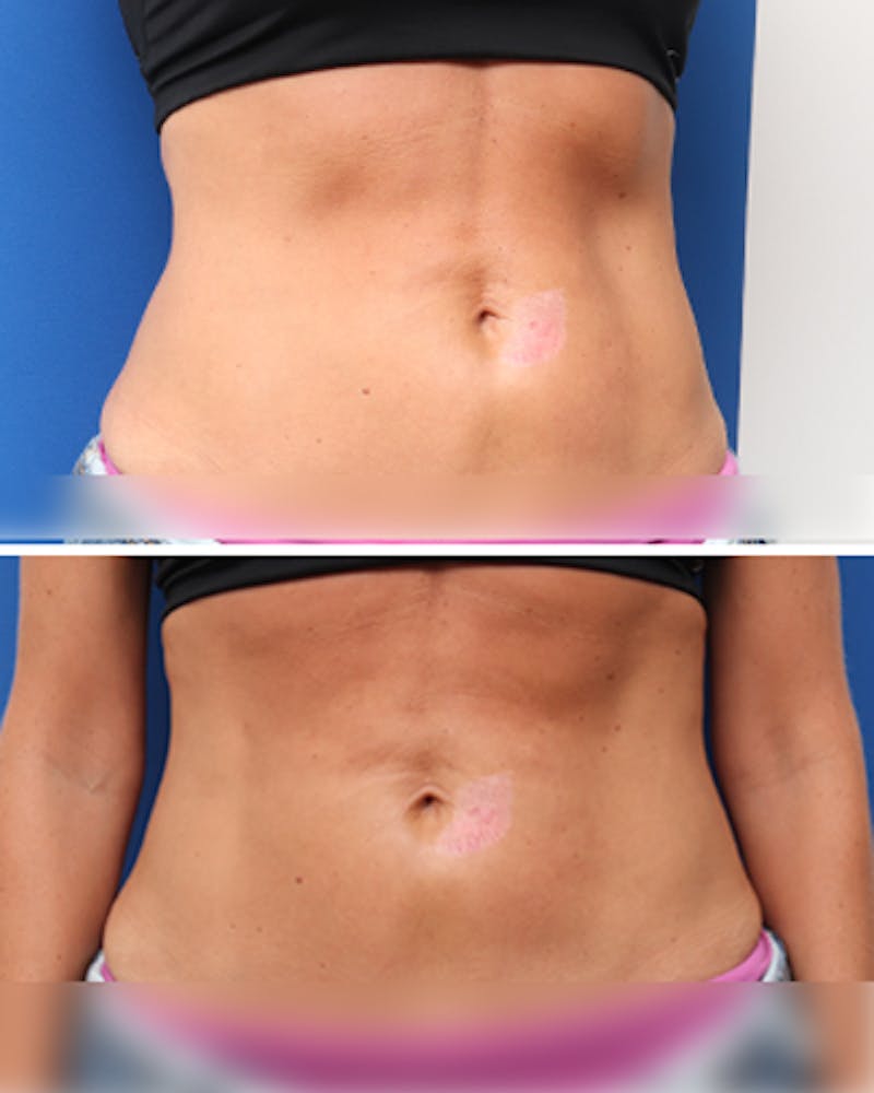 Patient Q-AXi-SQQBiLcqbDnGYBXw - Evolve Before & After Photos