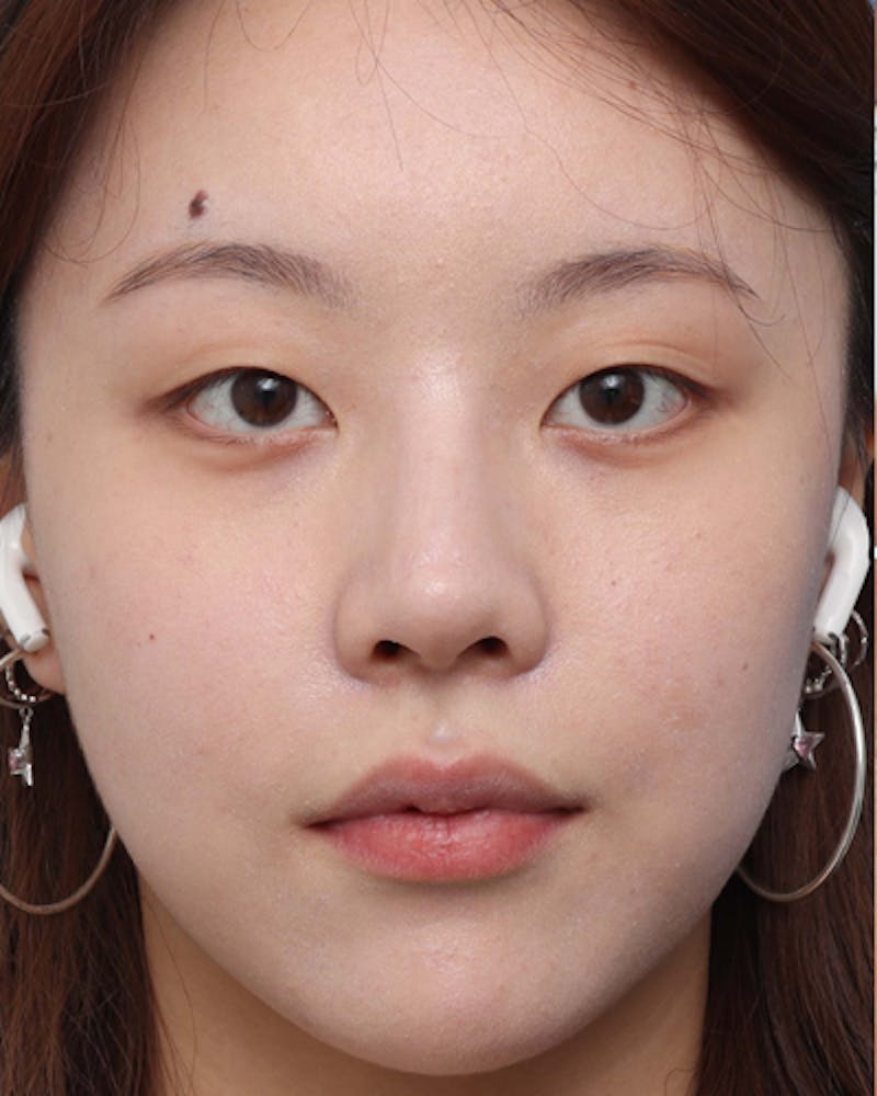 Non-Surgical Rhinoplasty Before & After Gallery - Patient 136947 - Image 6