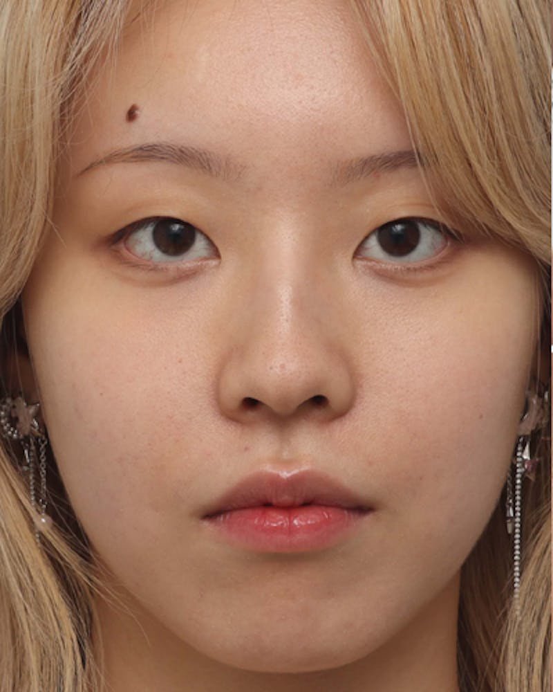 Non-Surgical Rhinoplasty Before & After Gallery - Patient 136947 - Image 5