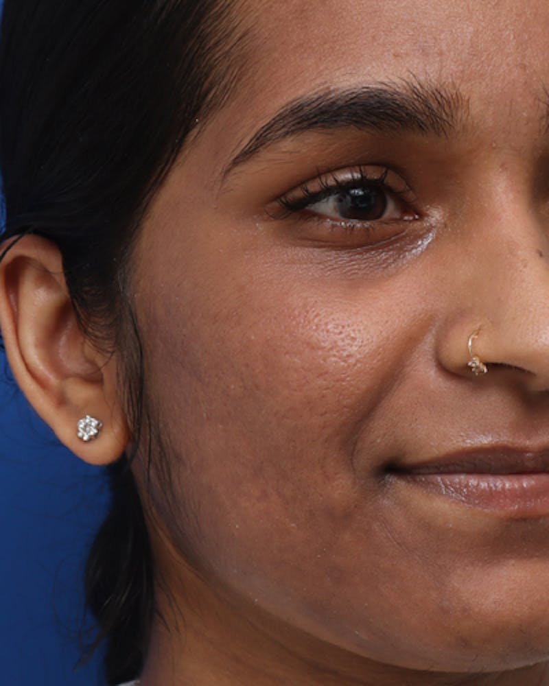Other Nonsurgical Before & After Gallery - Patient 245876 - Image 4