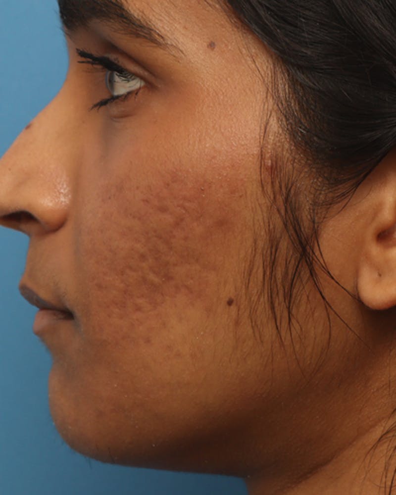 Patient ahV7WyLUSMKs138g_4nQuA - Microneedling Before & After Photos