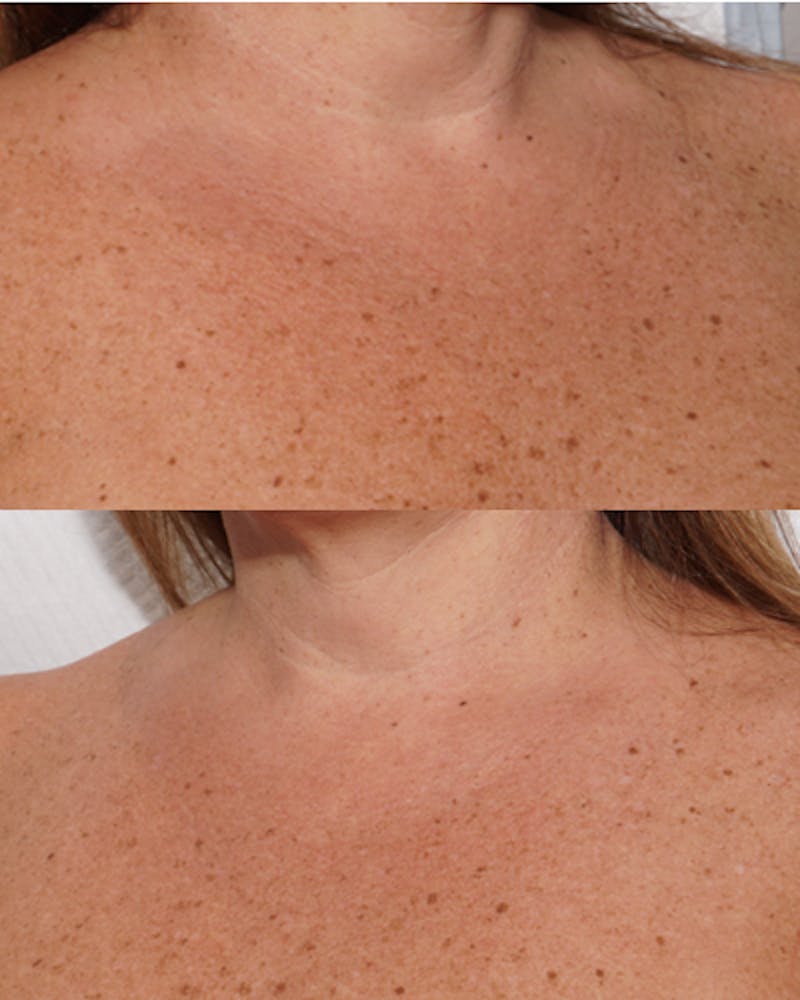 Other Nonsurgical Before & After Gallery - Patient 741895 - Image 3