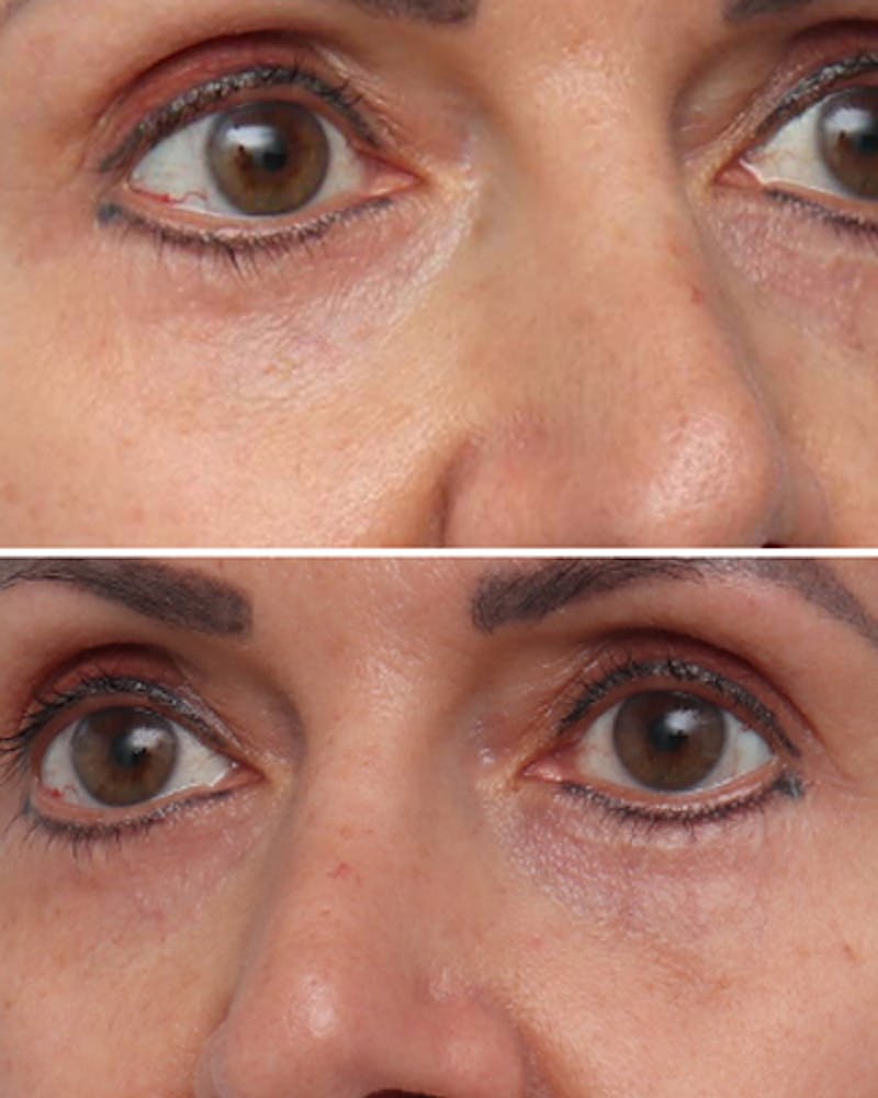Patient KlrCGsbySUOqeIfUMYF7-g - Chemical Peels Before & After Photos