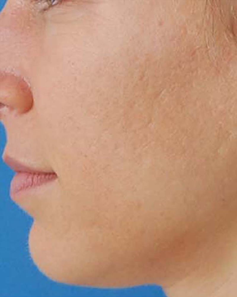 Other Nonsurgical Before & After Gallery - Patient 286064 - Image 4