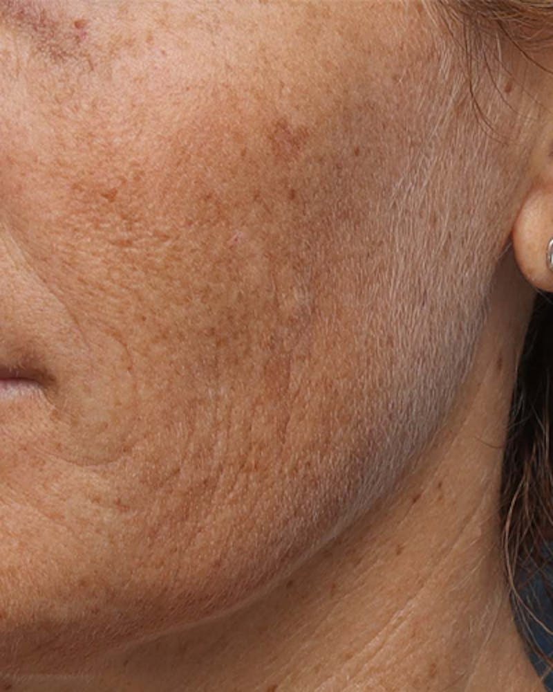 Other Nonsurgical Before & After Gallery - Patient 628813 - Image 3
