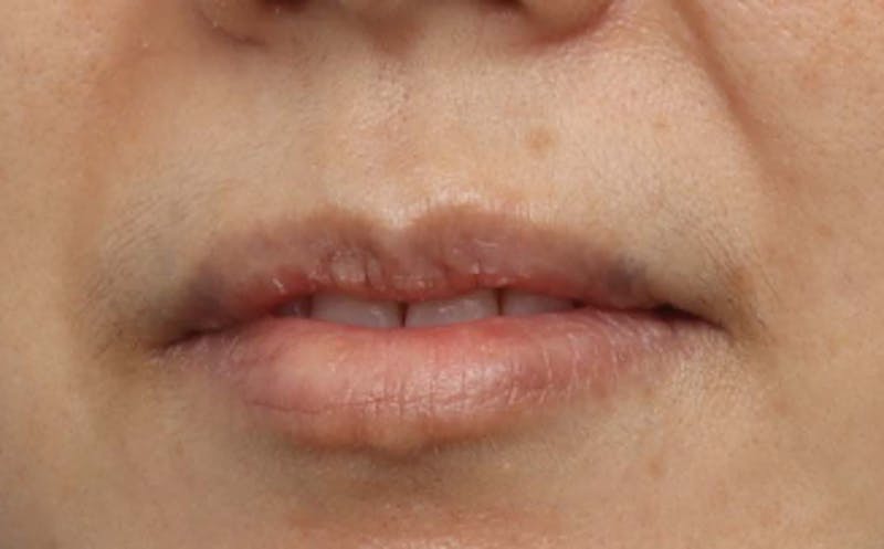 Lip Surgery Before & After Gallery - Patient 362755 - Image 4