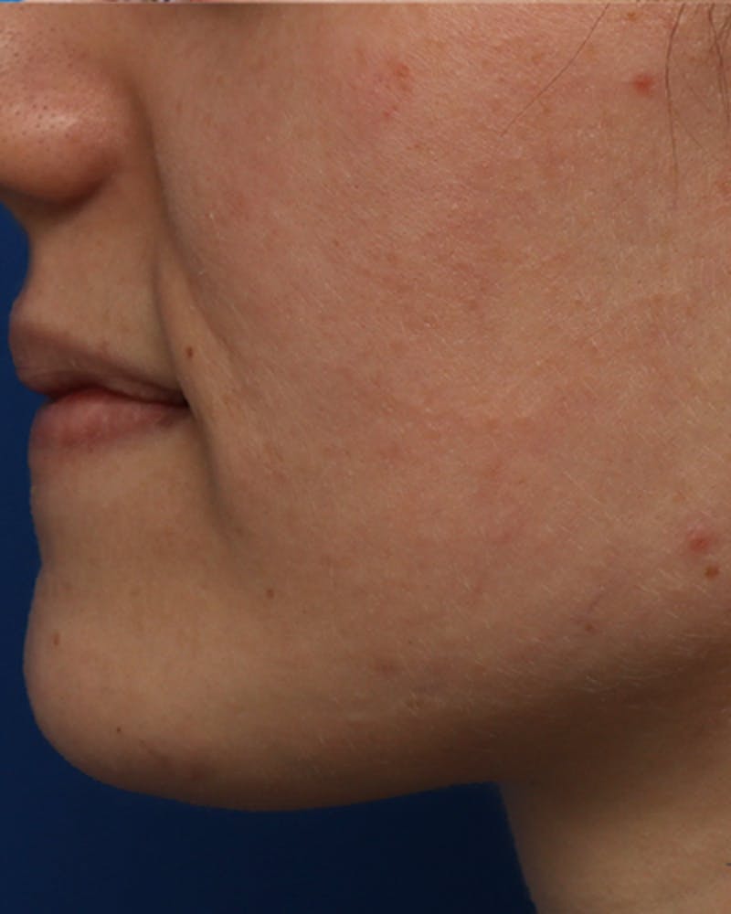 Patient Qx1Ig633RyG_PpQodD4IeQ - Microneedling Before & After Photos