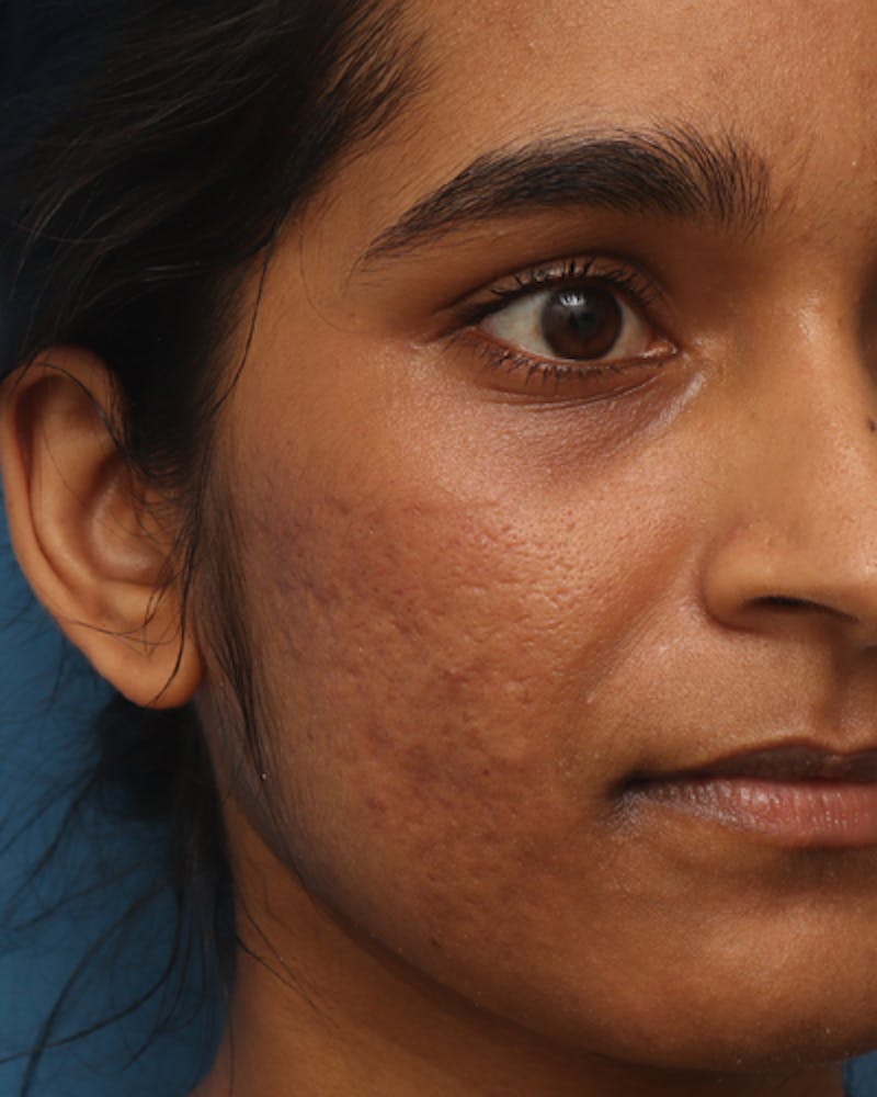 Other Nonsurgical Before & After Gallery - Patient 245876 - Image 3