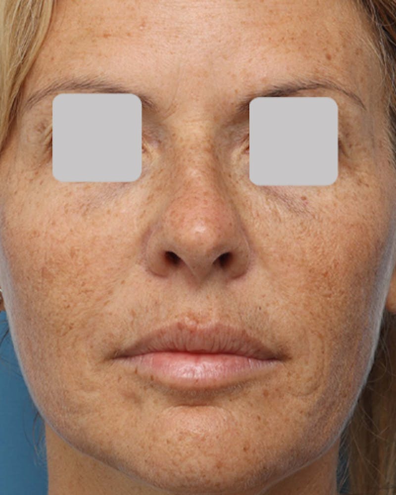 Patient BPmIh_jKQUSD_Zenqk1c3w - IPL Treatment Before & After Photos