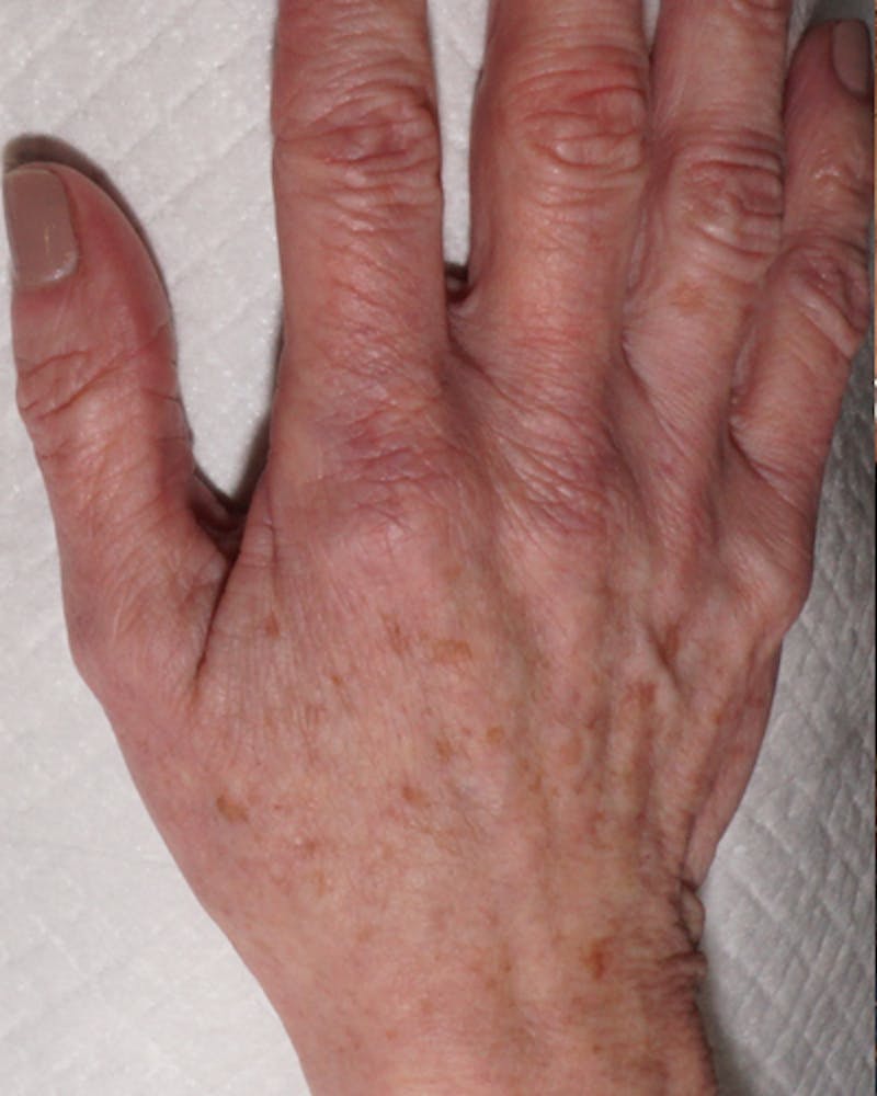 Patient UM4oNNaJSoWRDzb-mQiA3Q - IPL Treatment Before & After Photos