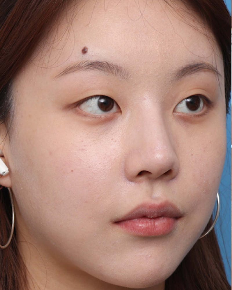 Non-Surgical Rhinoplasty Before & After Gallery - Patient 136947 - Image 4