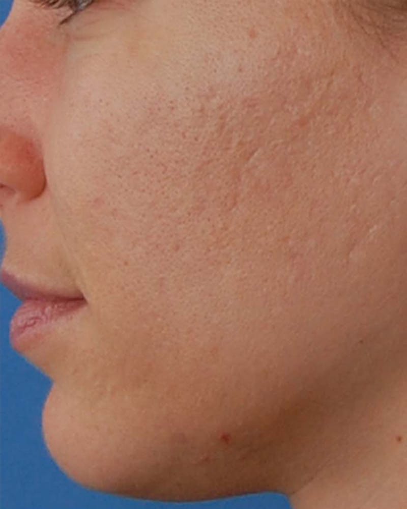 Other Nonsurgical Before & After Gallery - Patient 286064 - Image 3