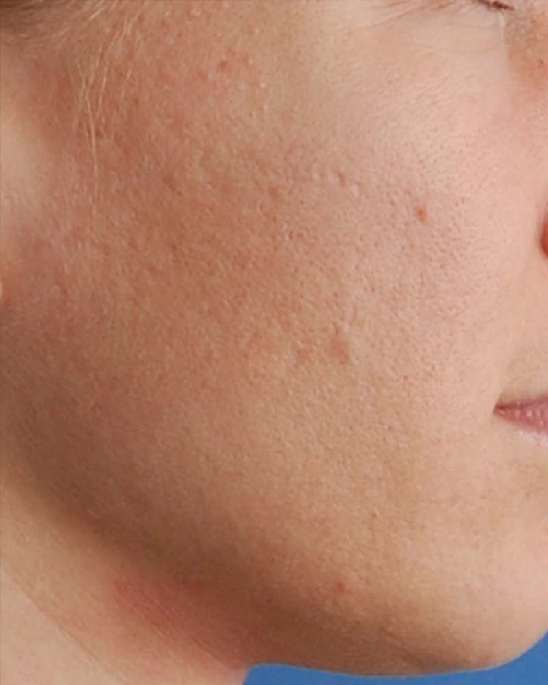 Patient UfzhLehSR9CoV8tRpcNmIA - Microneedling Before & After Photos