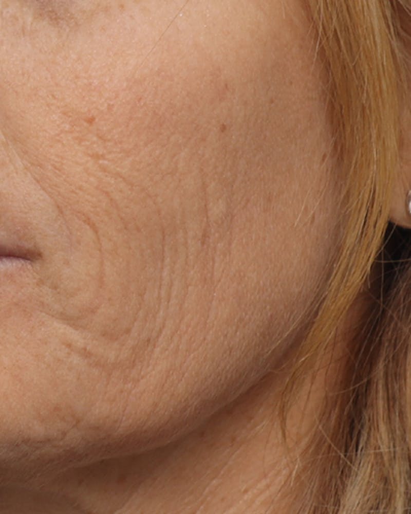 Other Nonsurgical Before & After Gallery - Patient 628813 - Image 4