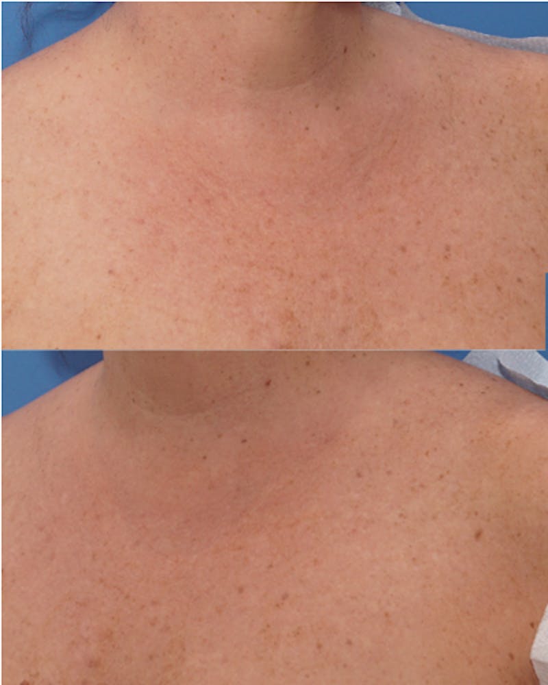 Other Nonsurgical Before & After Gallery - Patient 741895 - Image 4
