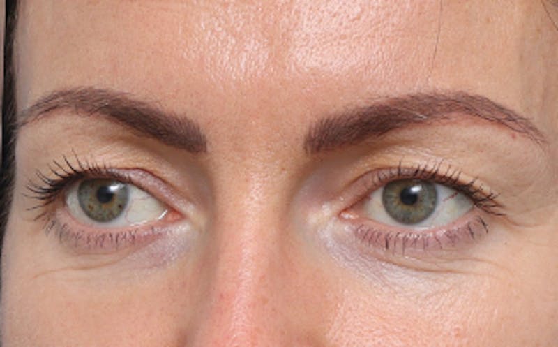 Fat Transfer Before & After Gallery - Patient 194550 - Image 3