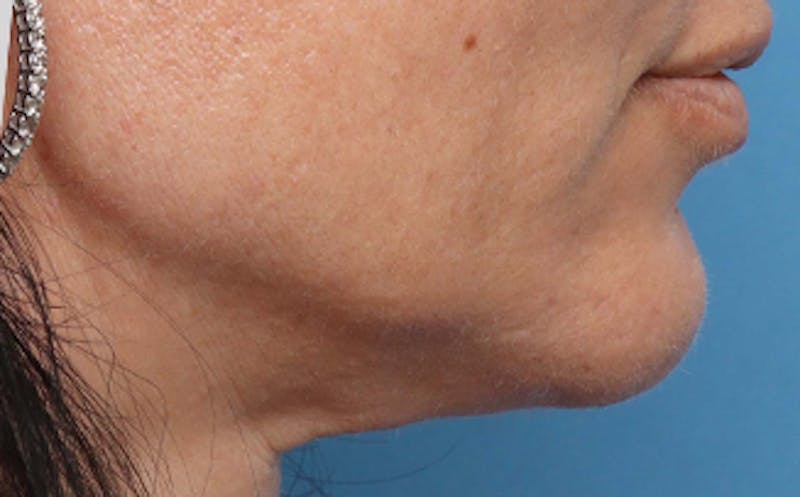 Fat Transfer Before & After Gallery - Patient 218698 - Image 4