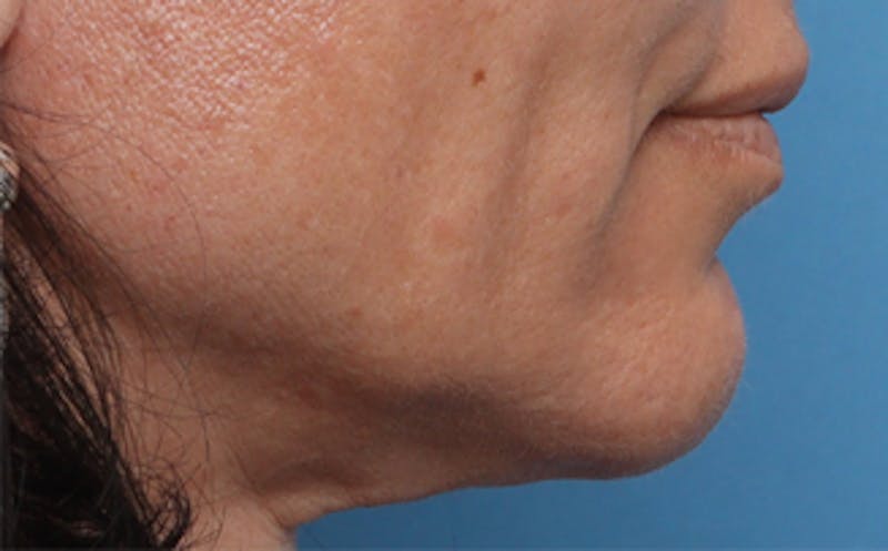 Fat Transfer Before & After Gallery - Patient 218698 - Image 3