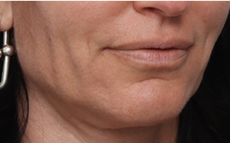 Patient D0w5prpuRdScyCNjta6wKA - Facial Fat Transfer Before & After Photos