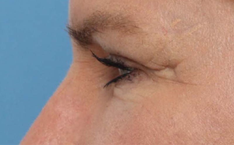Fat Transfer Before & After Gallery - Patient 821662 - Image 8