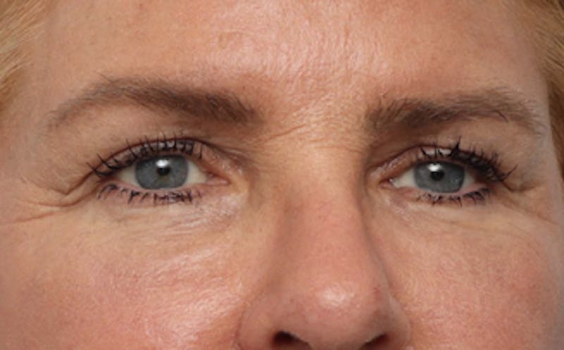 Fat Transfer Before & After Gallery - Patient 821662 - Image 6