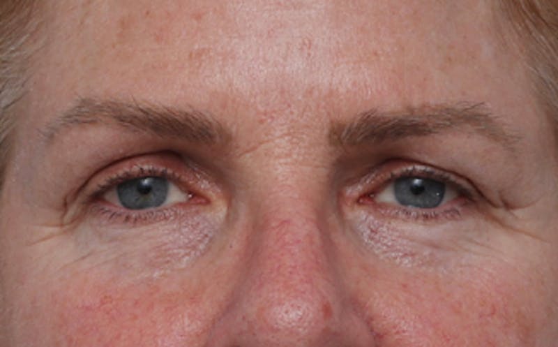 Patient dJodU4AgStqRxEln3KiyVw - Facial Fat Transfer Before & After Photos
