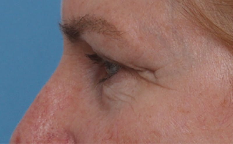 Fat Transfer Before & After Gallery - Patient 821662 - Image 7