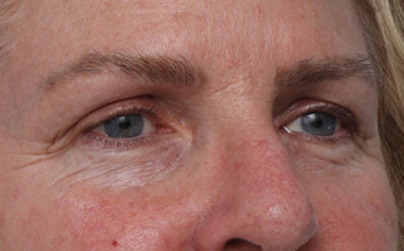 Fat Transfer Before & After Gallery - Patient 821662 - Image 5