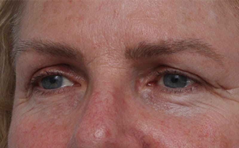 Fat Transfer Before & After Gallery - Patient 821662 - Image 3