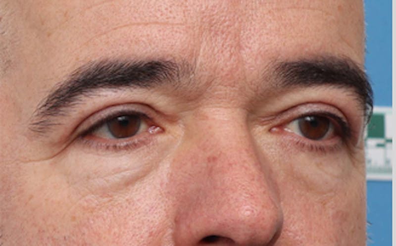 Eyelid Surgery Before & After Gallery - Patient 186016 - Image 4