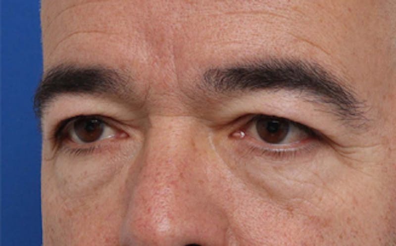Eyelid Surgery Before & After Gallery - Patient 186016 - Image 5