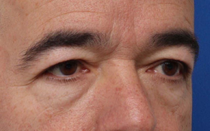 Eyelid Surgery Before & After Gallery - Patient 186016 - Image 3