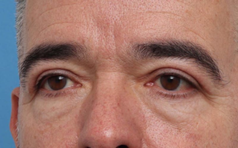 Eyelid Surgery Before & After Gallery - Patient 186016 - Image 6