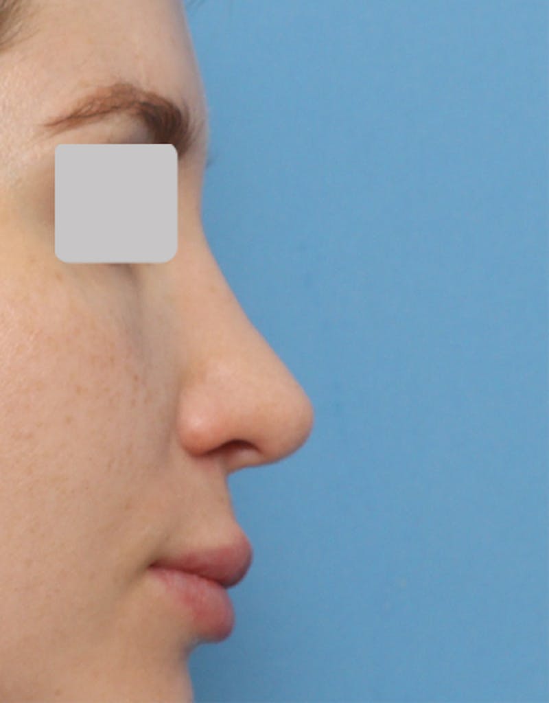 Favorite Revision Rhinoplasty Before & After Gallery - Patient 263507 - Image 4