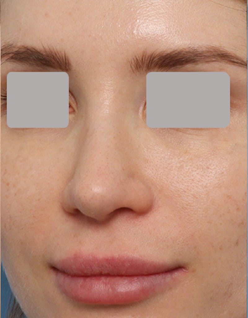 Favorite Revision Rhinoplasty Before & After Gallery - Patient 263507 - Image 8