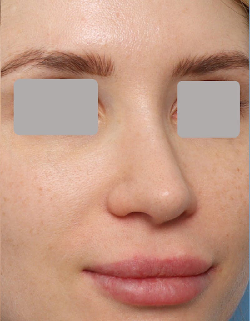 Favorite Revision Rhinoplasty Before & After Gallery - Patient 263507 - Image 6