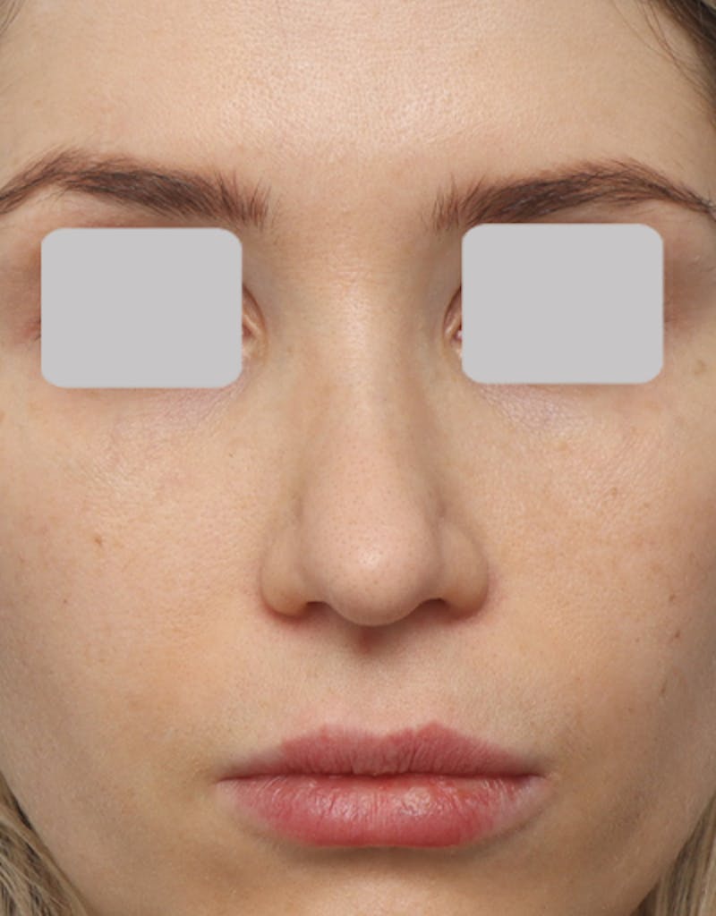 Patient ZRwRM4C7RZeU_JxHZas3eA - Rhinoplasty Before & After Photos