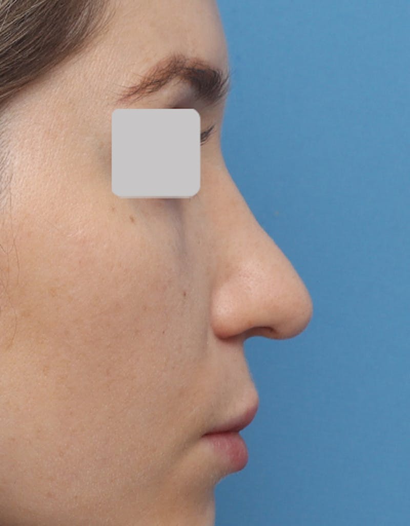 Favorite Revision Rhinoplasty Before & After Gallery - Patient 263507 - Image 3