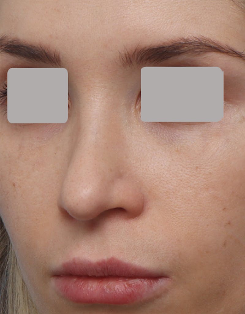 Favorite Revision Rhinoplasty Before & After Gallery - Patient 263507 - Image 7