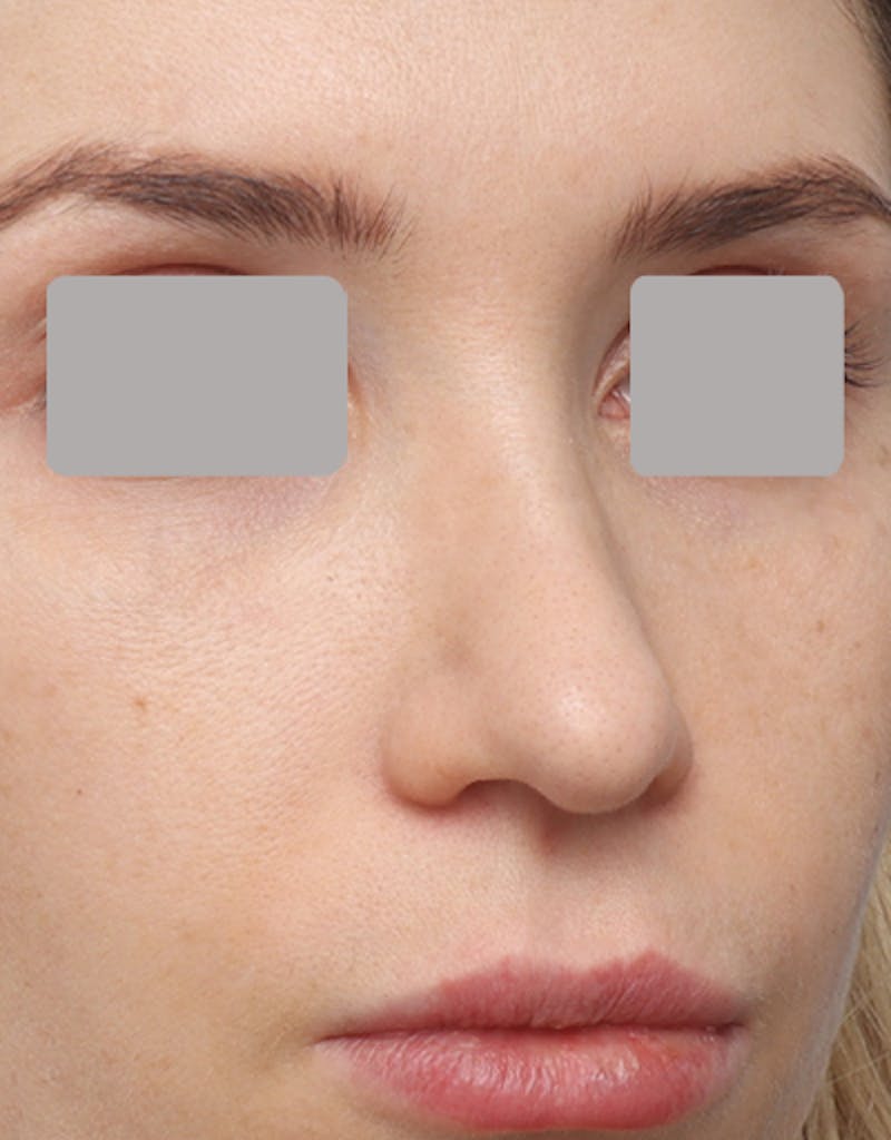 Favorite Revision Rhinoplasty Before & After Gallery - Patient 263507 - Image 5