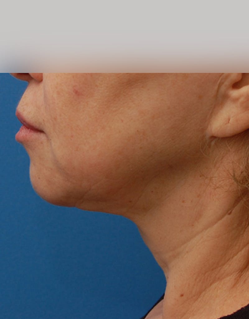 Facelift Before & After Gallery - Patient 107336 - Image 6