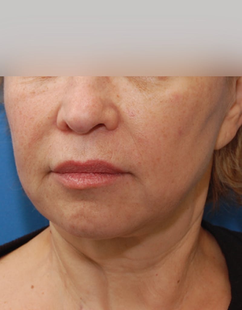 Facelift Before & After Gallery - Patient 107336 - Image 4