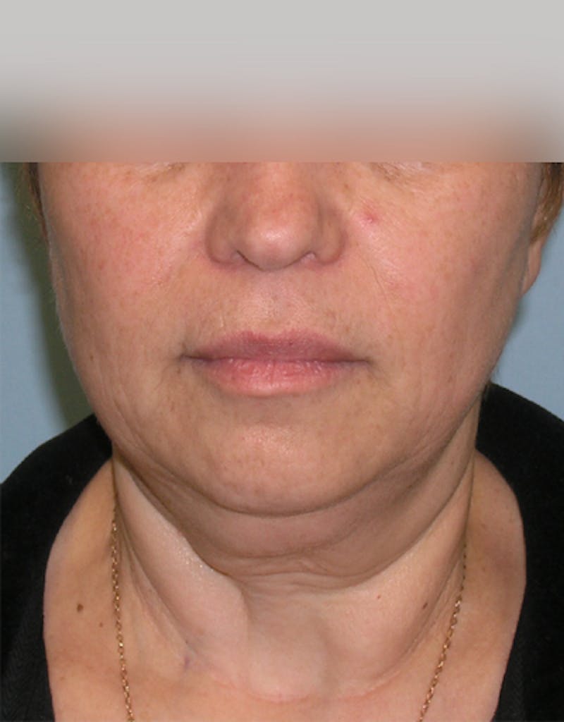 Patient MwQ1d2zIRKeLsRHOIzH08Q - Facelift Before & After Photos