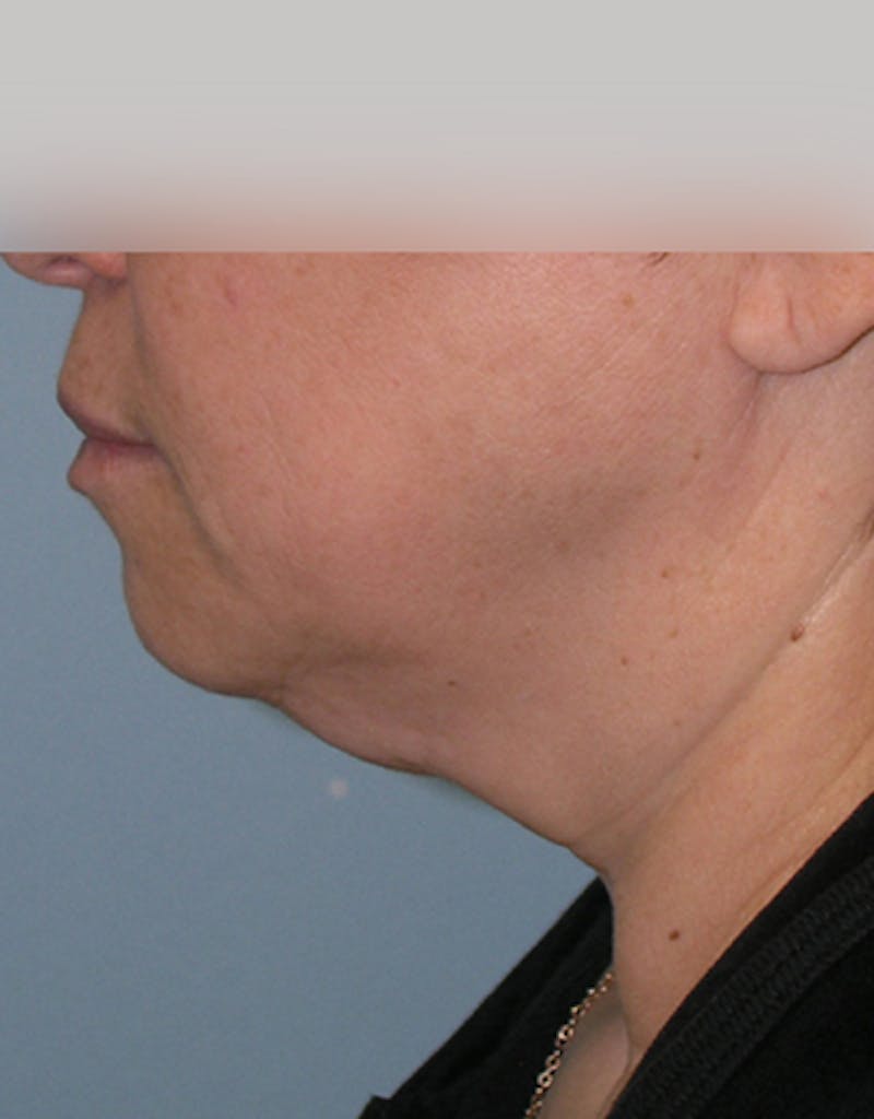 Facelift Before & After Gallery - Patient 107336 - Image 5
