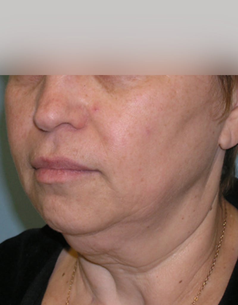 Facelift Before & After Gallery - Patient 107336 - Image 3