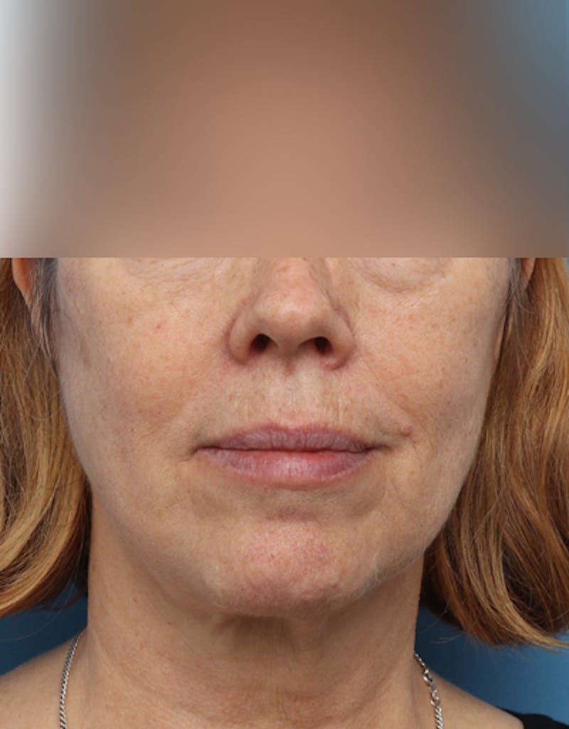 Facelift Before & After Gallery - Patient 319593 - Image 4