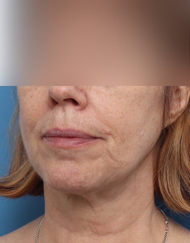 Facelift Before & After Gallery - Patient 319593 - Image 6