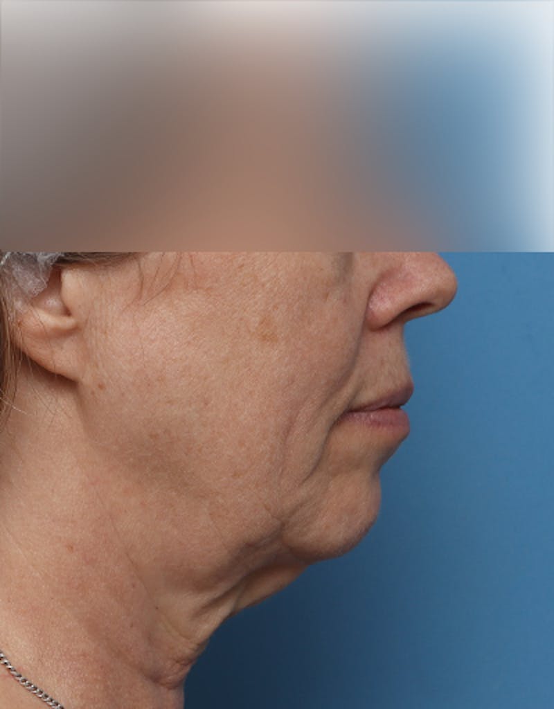 Patient dcDJH-yMTFqNWEEbQ1ynRg - Facelift Before & After Photos