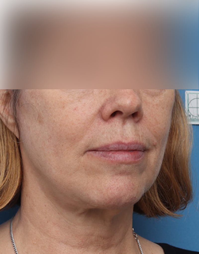Facelift Before & After Gallery - Patient 319593 - Image 8